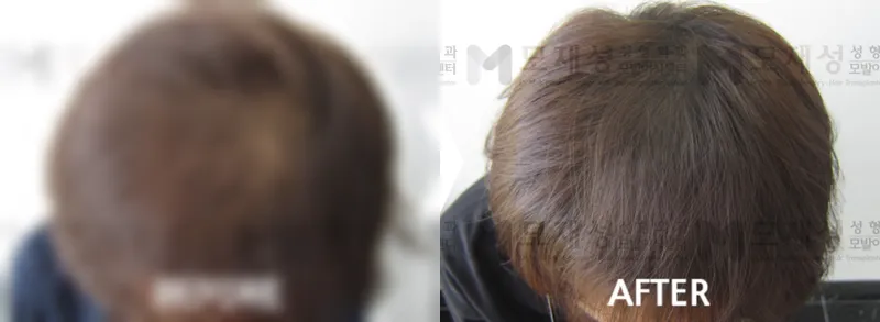 두피 색소 요법 시술 전후 가려진 수술 전 사진과 수술 후 사진