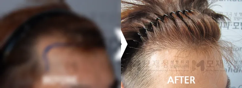 M자 탈모 2,800모 수술 전후 가려진 수술 전 사진과 수술 후 사진