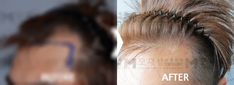 Receding hairline, 2,800 hairs: before and after surgery A blurred before photo and the after photo