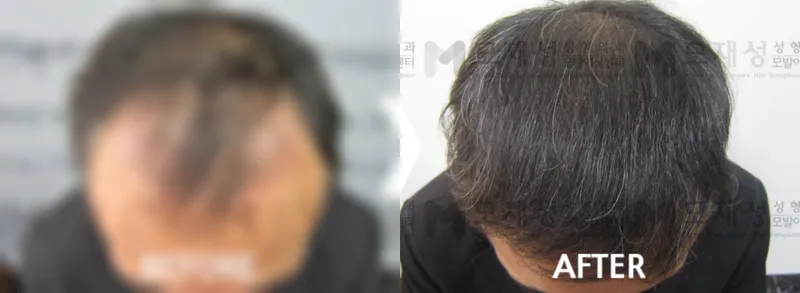 FUE移植2500个毛囊单位术前术后 已遮挡的术前照片与术后照片