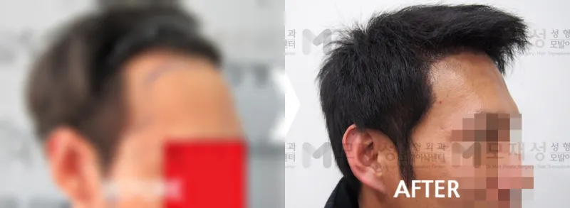 절개법 3,300모 모발이식 전후 가려진 수술 전 사진과 수술 후 사진