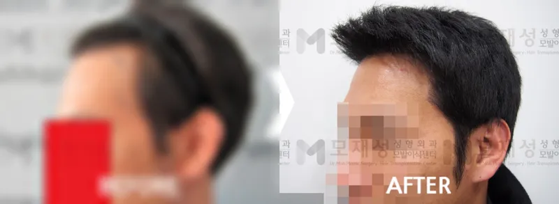 Strip hair transplant with 3,300 hairs: before and after A blurred before photo and the after photo