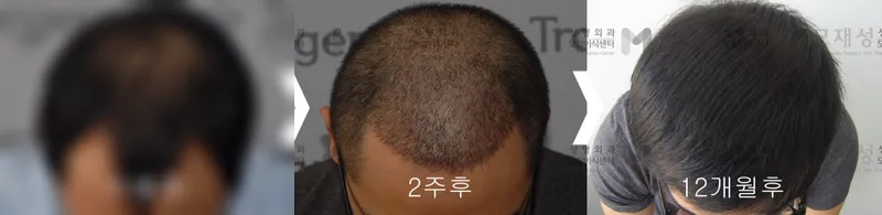 FUE with 2,900 follicular units: before and after surgery A blurred before photo and the after photo
