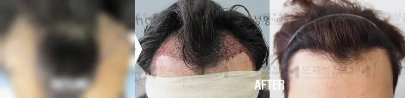 FUE with 1,870 follicular units: before and after surgery A blurred before photo and the after photo