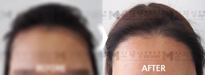 여성헤어라인 2,612모 수술전후 사진 가려진 수술 전 사진과 수술 후 사진