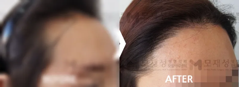 여성헤어라인 2,612모 수술전후 사진 가려진 수술 전 사진과 수술 후 사진