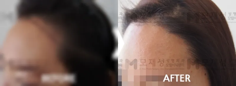 여성헤어라인 2,612모 수술전후 사진 가려진 수술 전 사진과 수술 후 사진