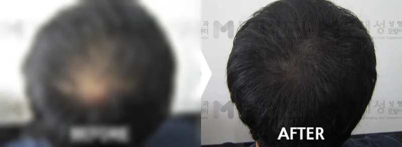 두피색소요법 시술전후 가려진 수술 전 사진과 수술 후 사진