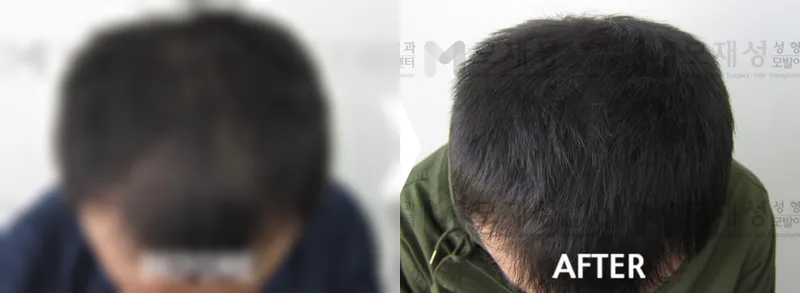 두피색소요법 시술 전후 가려진 수술 전 사진과 수술 후 사진