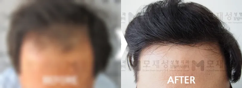 4,700모 절개법 이식후 1년 가려진 수술 전 사진과 수술 후 사진