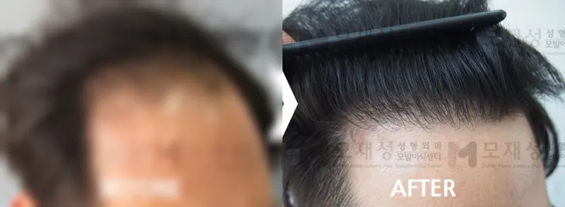 4,700모 절개법 이식후 1년 가려진 수술 전 사진과 수술 후 사진