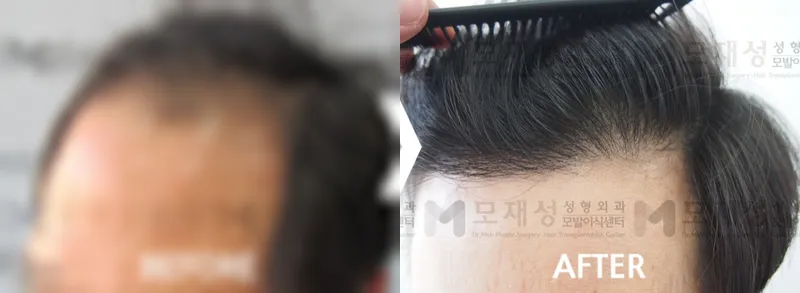 4,700모 절개법 이식후 1년 가려진 수술 전 사진과 수술 후 사진