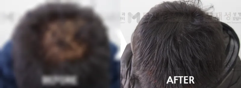 두피문신(두피색소요법) 시술전후 가려진 수술 전 사진과 수술 후 사진