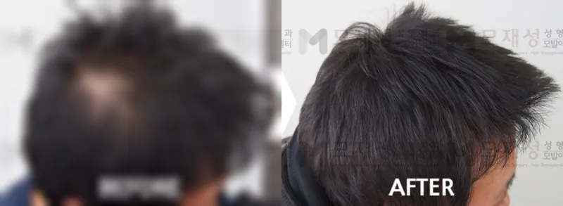 두피문신(두피색소요법) 시술전후 가려진 수술 전 사진과 수술 후 사진