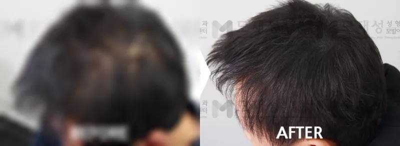 두피문신(두피색소요법) 시술전후 가려진 수술 전 사진과 수술 후 사진