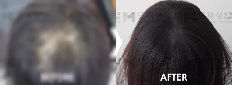 두피문신(두피색소요법) 시술전후 사진 가려진 수술 전 사진과 수술 후 사진