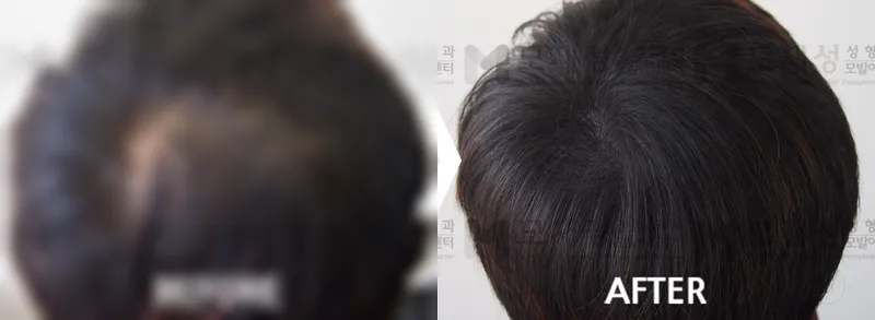 두피문신(두피색소요법) 시술 전후 가려진 수술 전 사진과 수술 후 사진