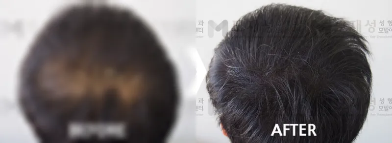 두피문신(두피색소요법) 시술전후 사진 가려진 수술 전 사진과 수술 후 사진
