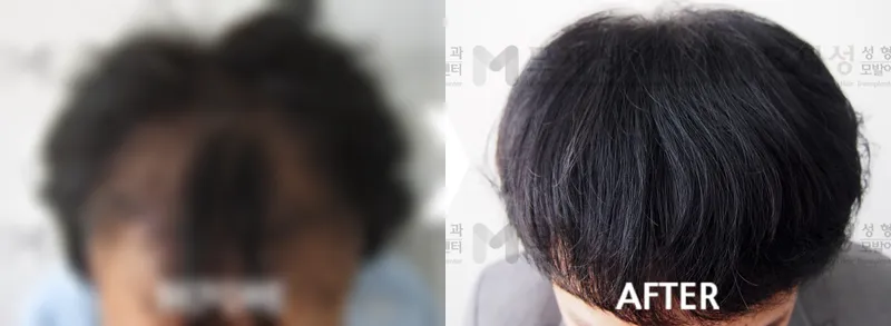 FUE with 1,700 follicular units: before-and-after photographs A blurred before photo and the after photo