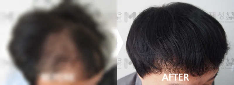 비절개 모발이식 1,700모낭 수술전후 사진 가려진 수술 전 사진과 수술 후 사진