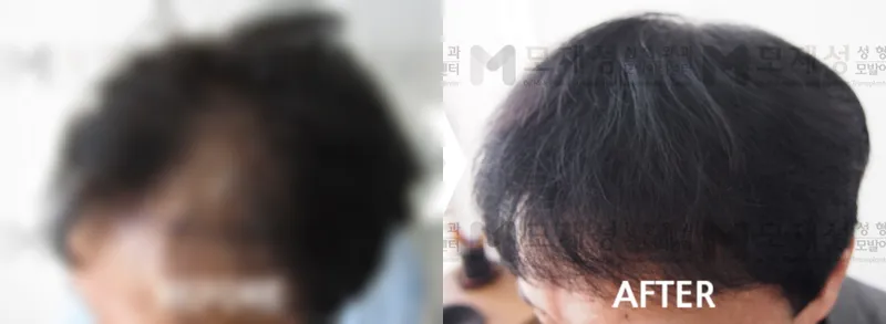 비절개 모발이식 1,700모낭 수술전후 사진 가려진 수술 전 사진과 수술 후 사진