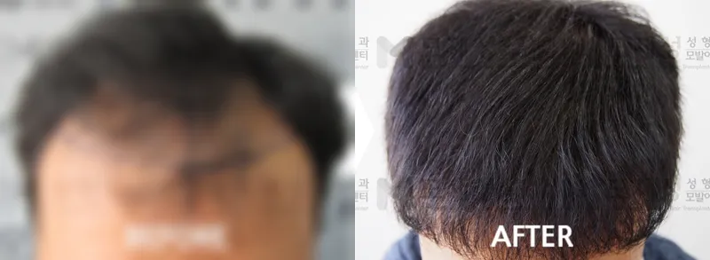 비절개 1,712모낭 수술전후 사진 가려진 수술 전 사진과 수술 후 사진
