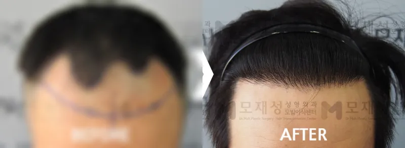 비절개 모발이식 1,992모낭 전후 가려진 수술 전 사진과 수술 후 사진