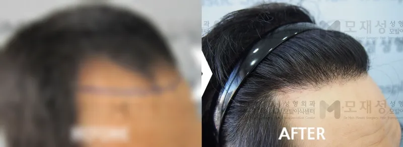 비절개 모발이식 1,992모낭 전후 가려진 수술 전 사진과 수술 후 사진