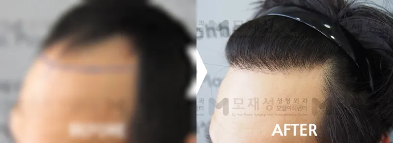 비절개 모발이식 1,992모낭 전후 가려진 수술 전 사진과 수술 후 사진