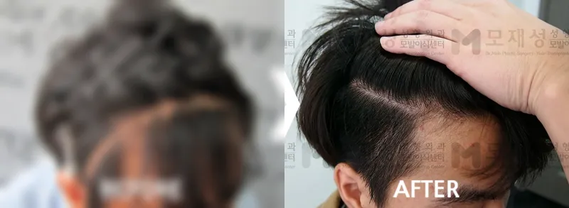 비절개 흉터 모발이식 가려진 수술 전 사진과 수술 후 사진