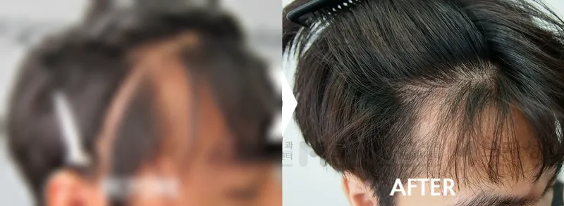 FUE瘢痕毛发移植 已遮挡的术前照片与术后照片