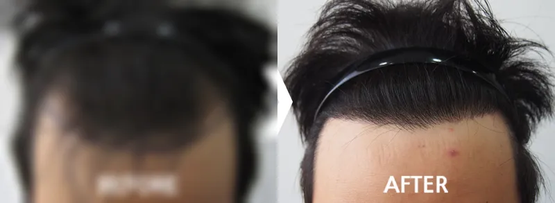 절개 모발이식 2,800모 수술전후 가려진 수술 전 사진과 수술 후 사진