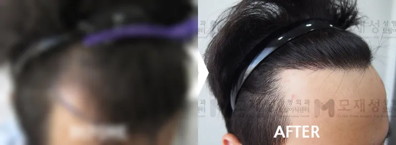절개 모발이식 2,800모 수술전후 가려진 수술 전 사진과 수술 후 사진