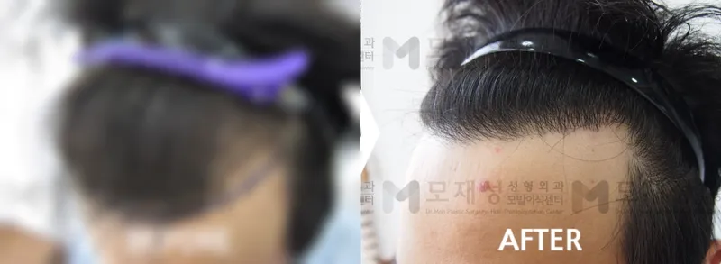 절개 모발이식 2,800모 수술전후 가려진 수술 전 사진과 수술 후 사진