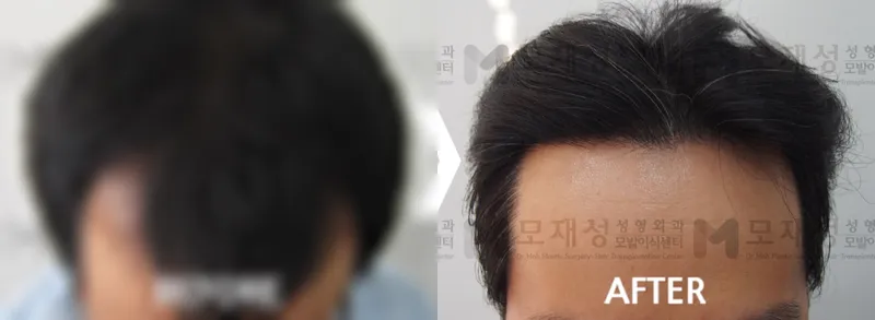 비절개 모발이식 1,920모낭 수술전후 가려진 수술 전 사진과 수술 후 사진