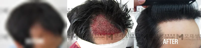 비절개 모발이식 1,920모낭 수술전후 가려진 수술 전 사진과 수술 후 사진