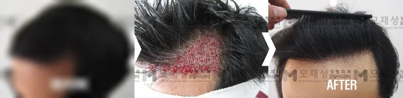 비절개 모발이식 1,920모낭 수술전후 가려진 수술 전 사진과 수술 후 사진