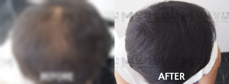 頭皮色素療法（SMP）の施術前後 ぼかした術前写真と術後写真