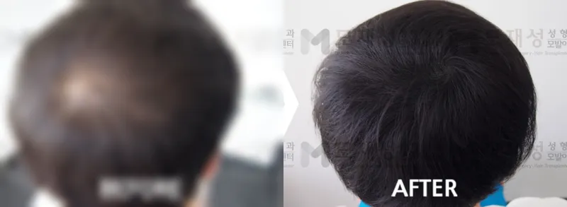 頭皮アートメイク（頭皮色素療法、scalp micropigmentation）施術前・施術後 ぼかした術前写真と術後写真