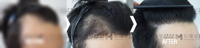 FUE毛发移植1906个毛囊单位，术后8个月 已遮挡的术前照片与术后照片