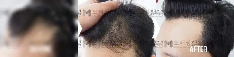 비절개 모발이식 1,906모낭 8개월 경과 가려진 수술 전 사진과 수술 후 사진
