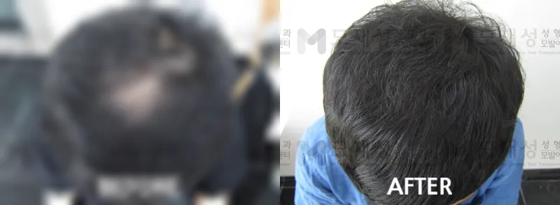 두피문신(두피색소요법, scalp micropigmentation) 시술전후 가려진 수술 전 사진과 수술 후 사진