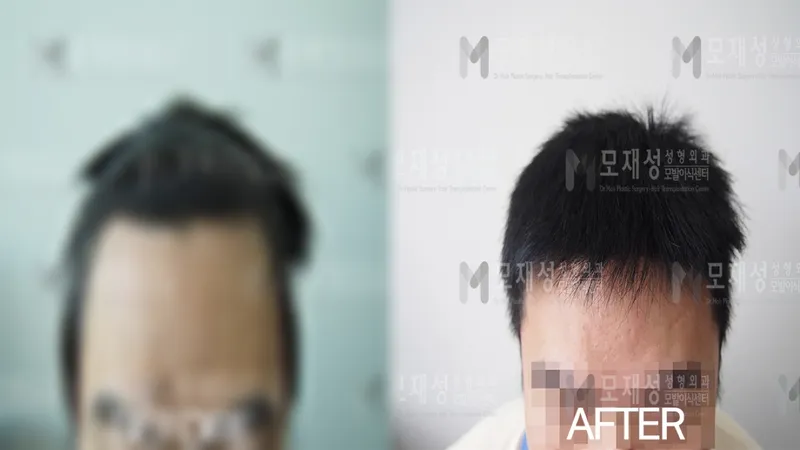 FUE移植1700个毛囊单位的术前术后照片 已遮挡的术前照片与术后照片