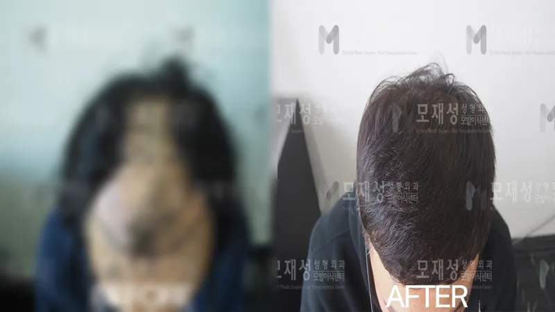 비절개 3,000모낭 전후사진 가려진 수술 전 사진과 수술 후 사진