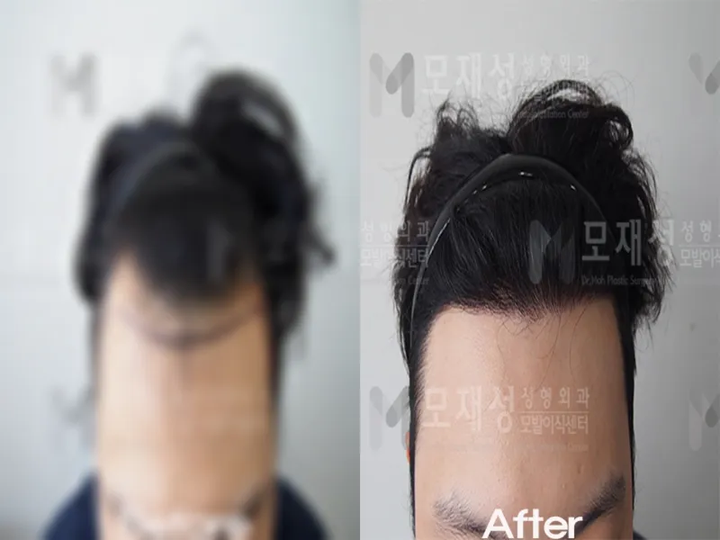 FUE移植1500个毛囊单位的术前术后照片 已遮挡的术前照片与术后照片