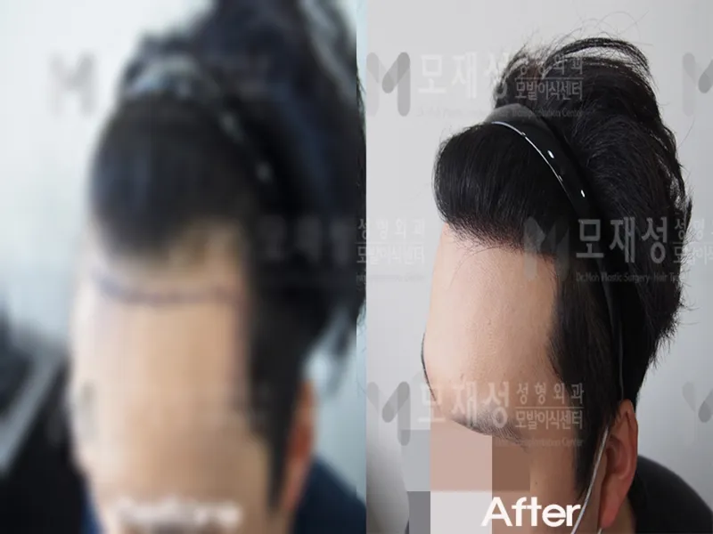 비절개 1,500모낭 전후사진 가려진 수술 전 사진과 수술 후 사진