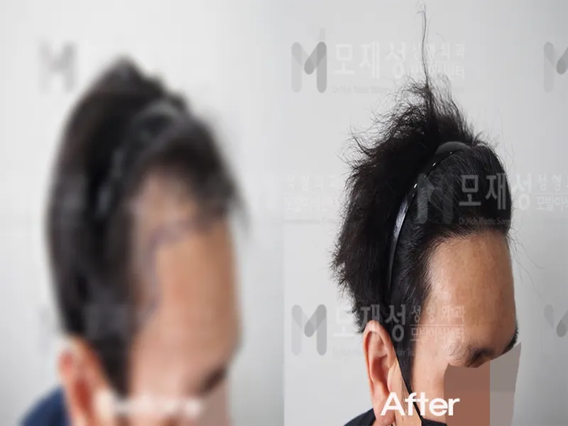 비절개 1,700모낭 전후사진 가려진 수술 전 사진과 수술 후 사진