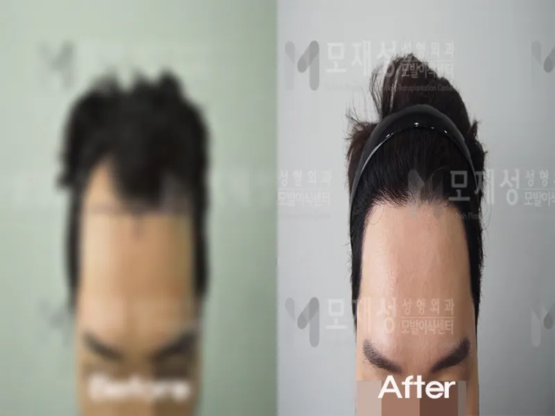 비절개 1,600모낭 전후사진 가려진 수술 전 사진과 수술 후 사진