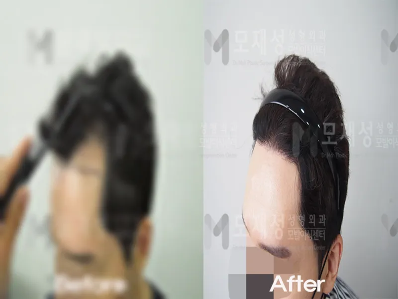 비절개 1,600모낭 전후사진 가려진 수술 전 사진과 수술 후 사진
