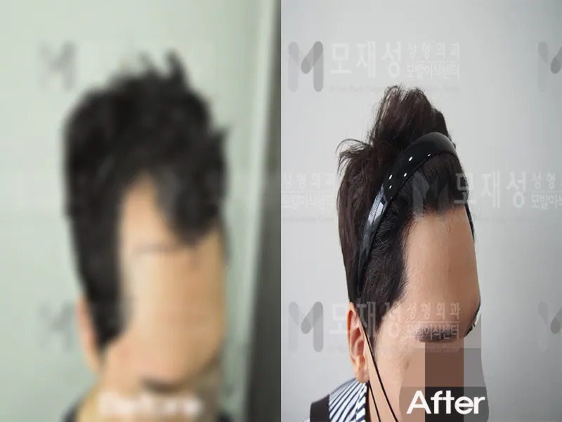 비절개 1,600모낭 전후사진 가려진 수술 전 사진과 수술 후 사진